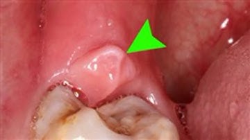 4 thời điểm tuyệt đối không được nhổ răng khôn kẻo gây biến chứng nguy hại tới sức khỏe