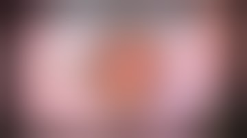 CataractCoach 1419: how to reposition a toric IOL