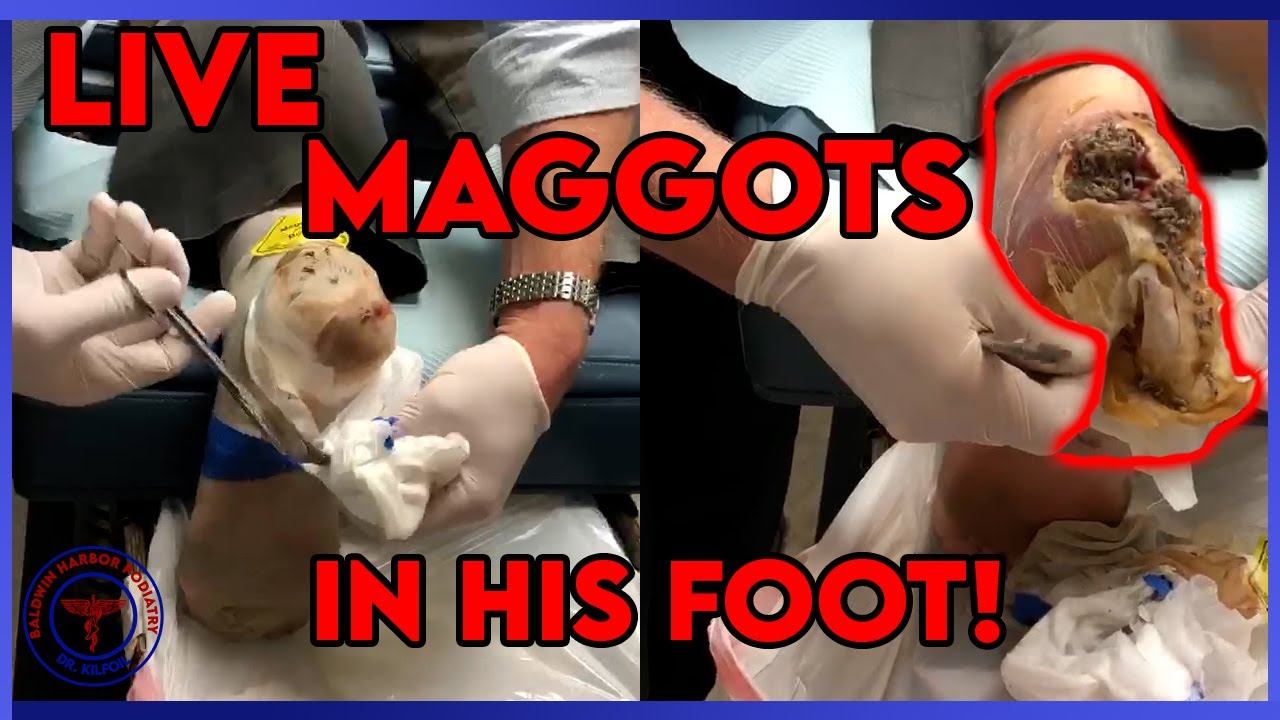 Larva Therapy For Diabetic Foot Wounds (Live Maggots In Foot!)