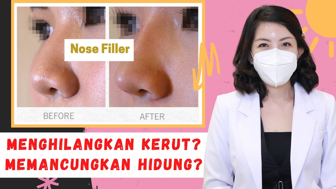 Empat Jenis Filler Untuk Wajah. Menambah Volume Hidung, Mengurangi Kerut.
