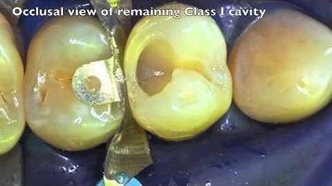 Ceram.x universal SpereTec, SDR and Palodent V3 case report