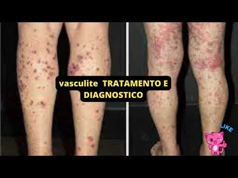 vasculite TRATAMENTO E