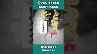 Cork screw Esophagus in Diffused Esophagial spasm: radiology made simple for USMLE, NEET PG, NCLEX