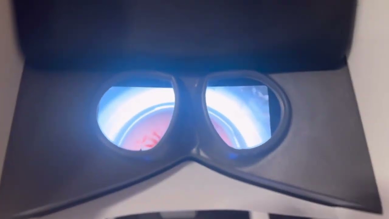 Robotic Single Port SP Partial Nephrectomy Low Anterior Retroperitoneal Access