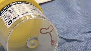 Live worm removed from woman’s brain in world-first discovery