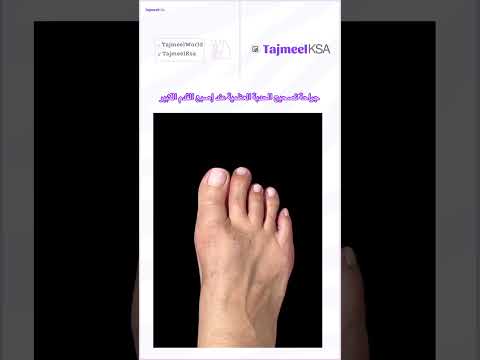 ود ع آلام أصبع القدم الكبير كيف تتخلص من الحدبة العظمية بالجراحة تجميل