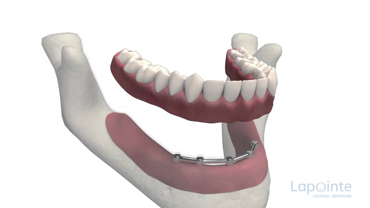 Prothèse complète sur implants - Centres dentaires Lapointe - YouTube