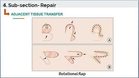 Integumentary system - Adjacent Tissue Transfer - Current Procedural Terminology
