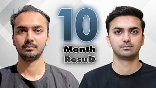 3500+ Grafts | Before After Hair Transplant Results| 22 years AGE | Dr. Vivek Galani | RQC
