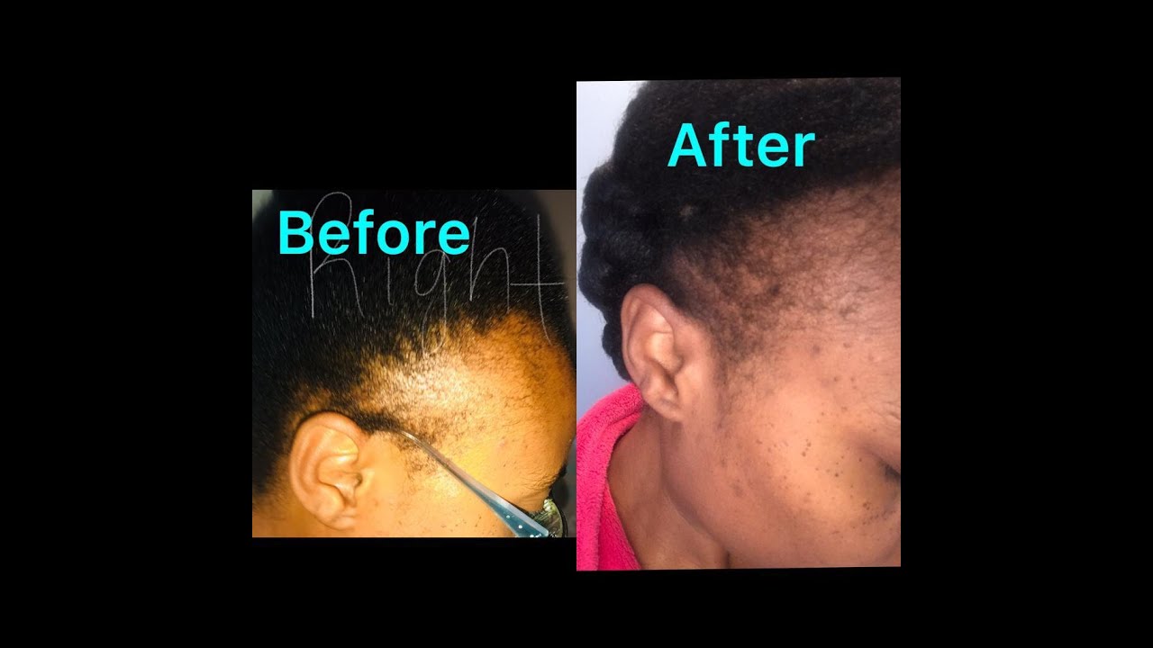 PRODUCTS TO HEAL THE SCALP PROMOTING HAIR GROWTH YouTube