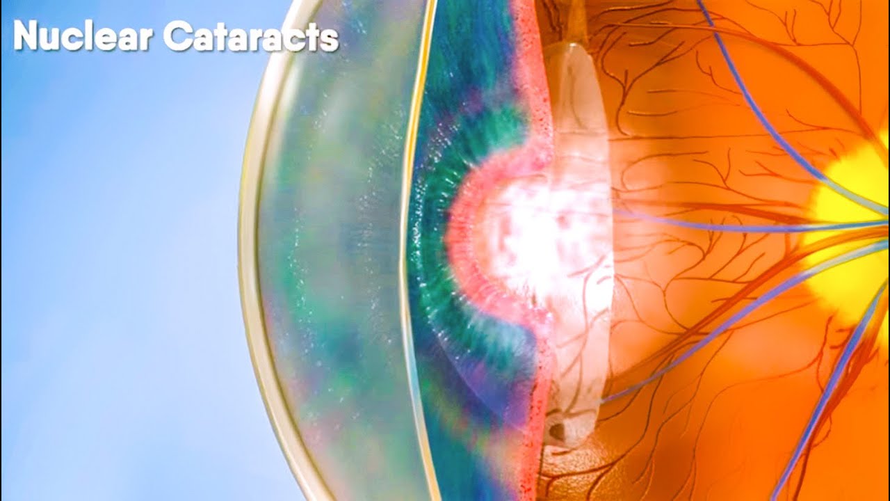 ⁣Do you know there are different types of cataracts? Dandelion Medical Animation