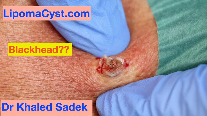 Is it a Blackhead? Let me know...Dr Khaled Sadek. ...