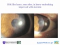 Long term follow up of Athens protocol for keratoconus (top PRK CXL)