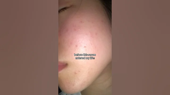 The VIRAL OG Korea serum for acne🤍 #celimax
