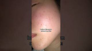 The VIRAL OG Korea serum for acne🤍 #celimax