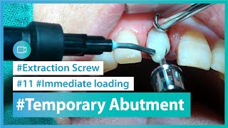 Provisional restoration with temporary abutment in immediate implant placement screenshot 4