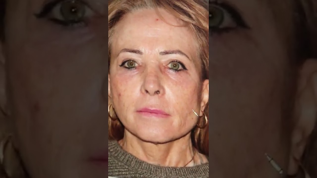 Le lifting des peaux très ridées associé au laser Co2 fractionné