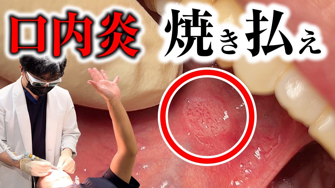 口内炎 レーザー 治療