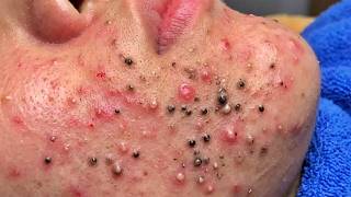 Blackhead Removal With Today Spa #2651