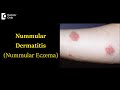 Nummular Dermatitis (Nummular Eczema) Causes , Symptoms and Treatment-Dr. Nischal K| Doctors