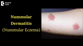 Nummular Dermatitis (Nummular Eczema) Causes , Symptoms and Treatment-Dr. Nischal K| Doctors' Circle