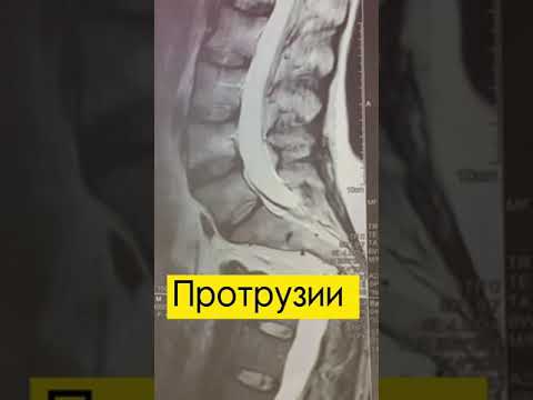 Как выглядит фиброз мышц на МРТ