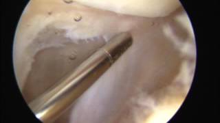 Quadriceps tendon surgery - Shaving of the quadriceps tendon