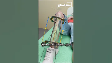 كيف ت جرى جراحة الساق 