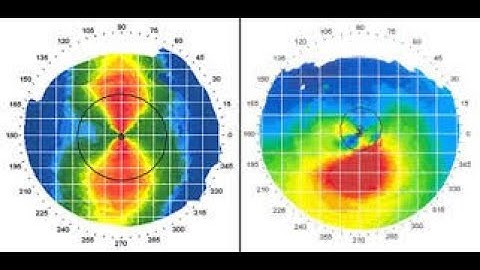 What you have to know about  Risk Assessment with Pentacam, Dr. Hossam Ziada