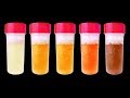 Red, brown, green: Urine colors and what they might mean |  Dr. N Upendra Kumar