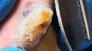 The Thick Callus On One Side Of The Toe Is Shaved Off Piece By Piece【Podiatry Clinic】