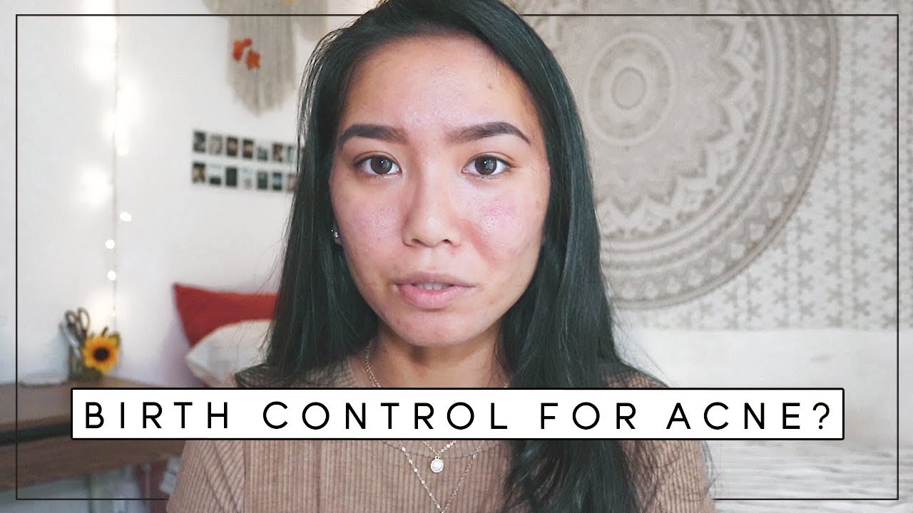 How The Pill Affected My Skin Acne Update YouTube