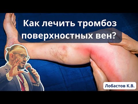 Доклад: "Как лечить тромбоз поверхностных вен?" (03.06.2023)