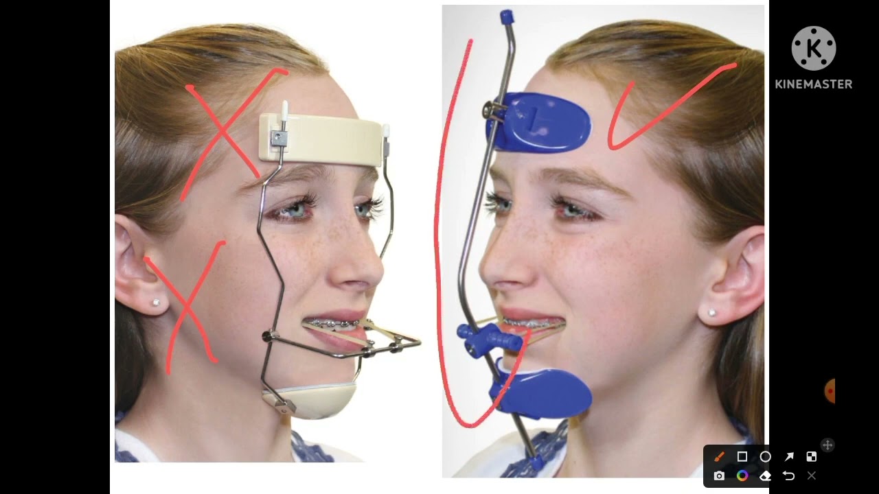 Face mask appliance from A to Z (Part 1). Dr Hanee O Hashem YouTube