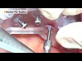 Implant placement using osstem guided surgery system oneguide