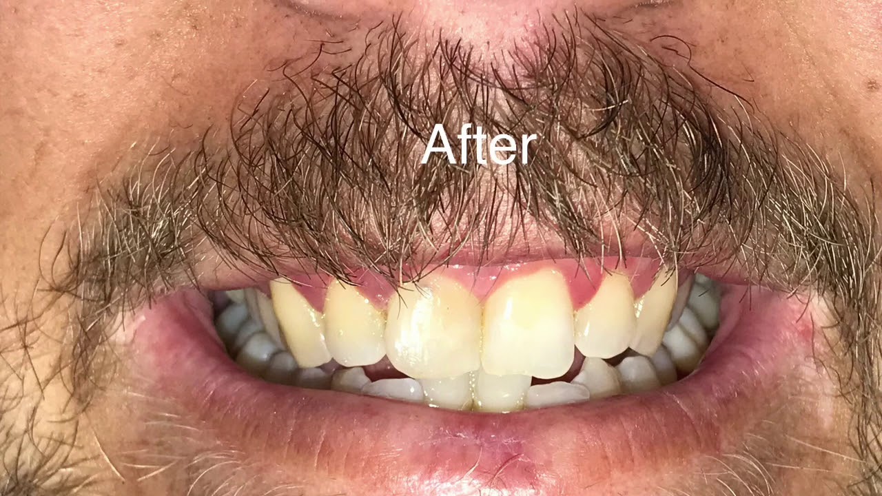 how to fix a cavity on a tooth YouTube