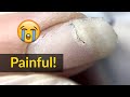 Expert Nail Care: Fixing Painful Nail Cracks with Acrylic