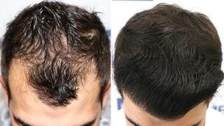 FUE Hair Transplant (2500 Grafts NW III A) By Dr Juan Couto - FUEXPERT CLINIC, Madrid, Spain
