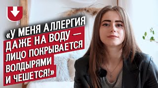 У меня аллергия на все: Оля | Быть молодым