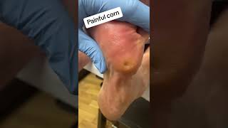 Very painful corn removal from foot by podiatrist with scalpel #foot #callus #podiatrist #ergonx #do screenshot 5