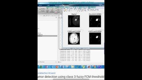 Brain tumor detection using class 3 fuzzy FCM threshold - Matlab Code