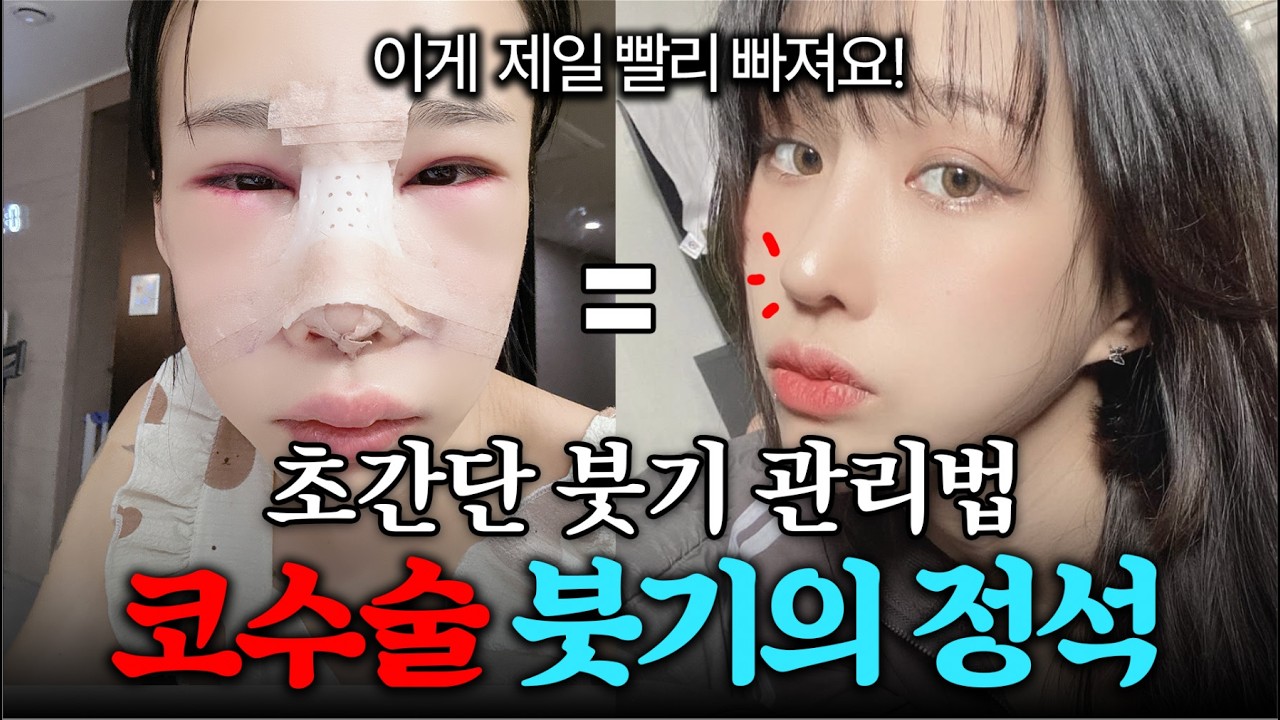 코 성형만 8번 하고 알게 된 사실...