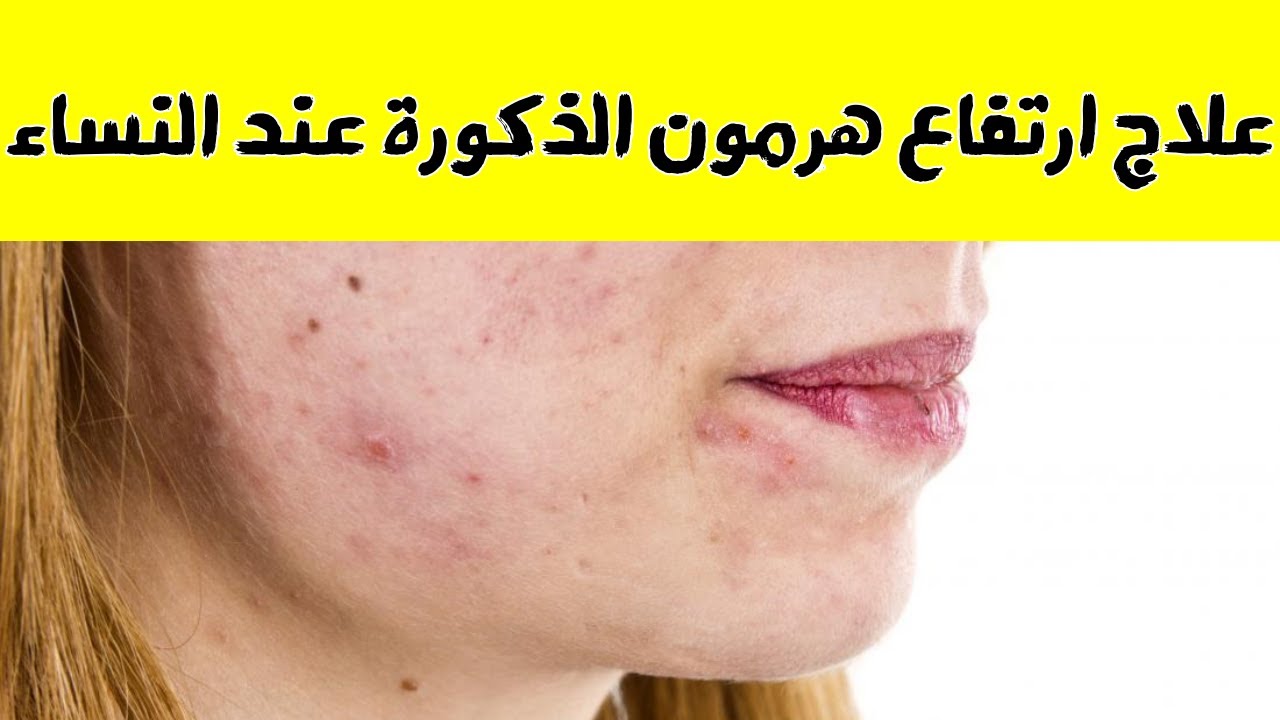 په ښځو کې نارینه هورمون څنګه کمیږي؟