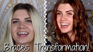 My Braces Transformation! | Christene Renshaw