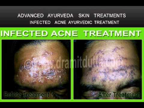 Acne , Pimples  , Cystic Acne and Rosacea Ayurvedic Treatment