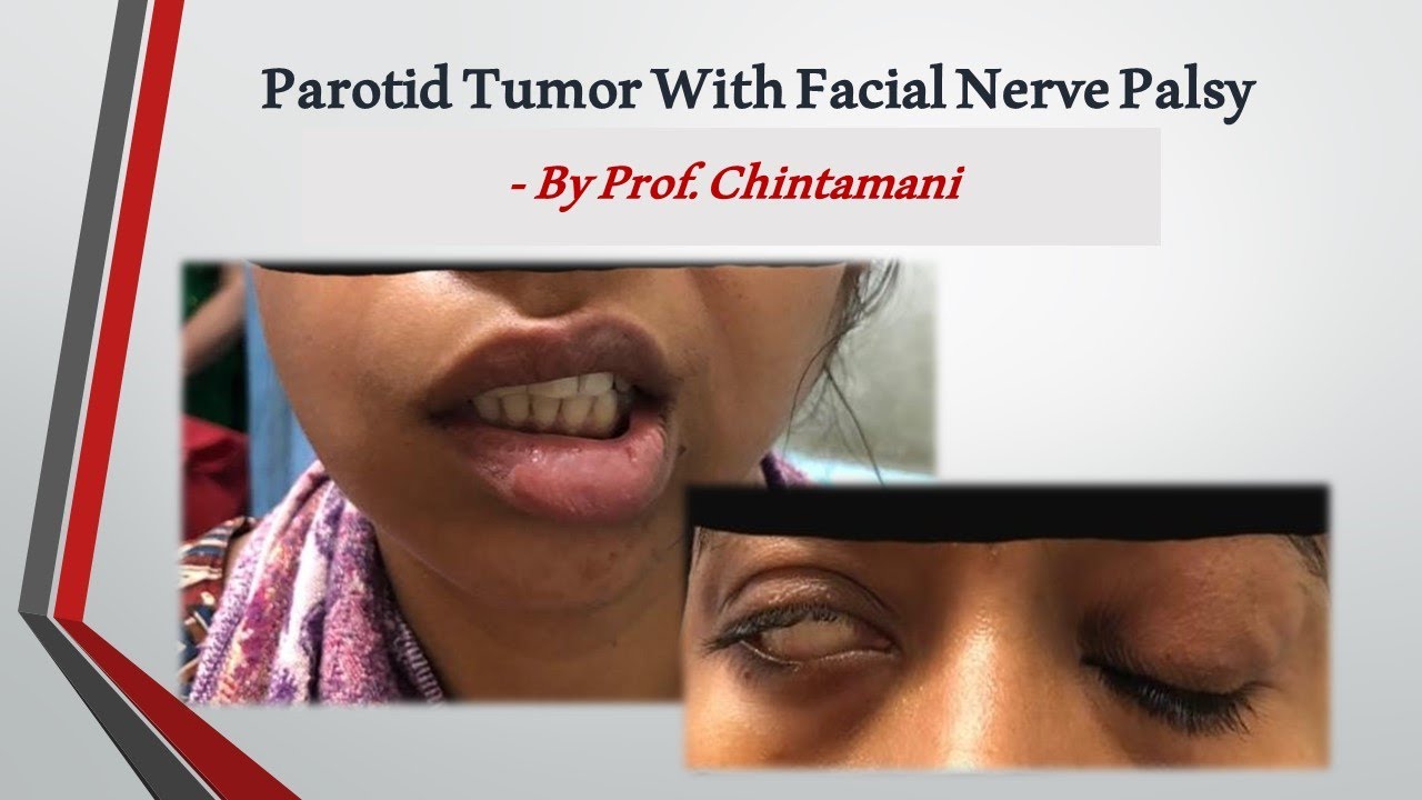 Parotid swelling - Approach and Management by Prof. Chintamani