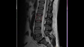 Interactive-Cut: Real-time segmentation of vertebral bodies and discs