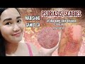 MABISANG GAMOT SA PSORIASIS, SCABIES AT IBA PANG SKIN DISEASES+PAANO GAMITIN|ALL ABOUT BELLE