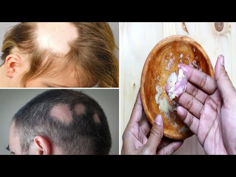 Video: Tratamentul Alopeciei Cu Medicamente