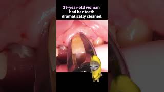 【29-y/o woman👩】She dramatically cleaned her ragged teeth. #ザホワイトデンタルクリニック #歯医者 #bananacat